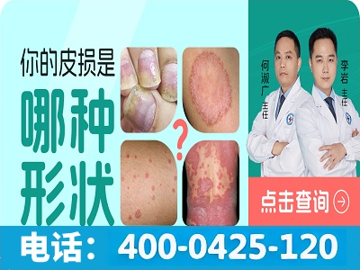 苏州哪所医院治疗银屑病疗效好